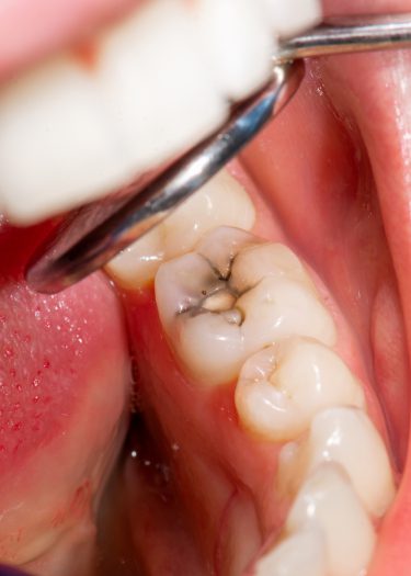 Tooth cavity