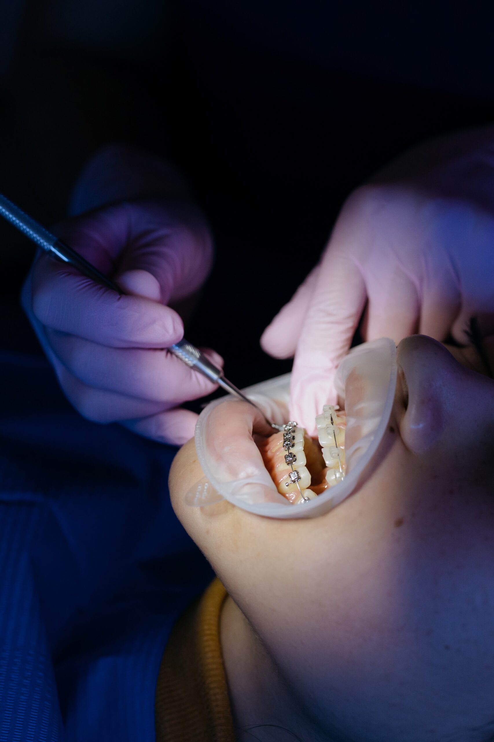 Dentist putting braces